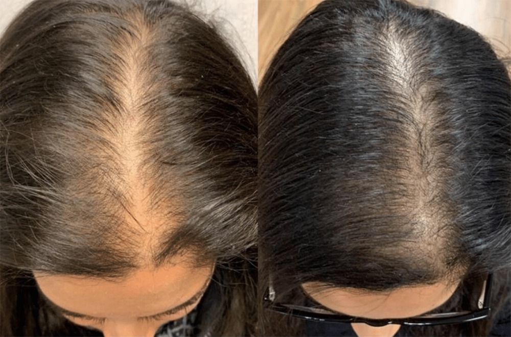 PRP Treatment in Hyderabad