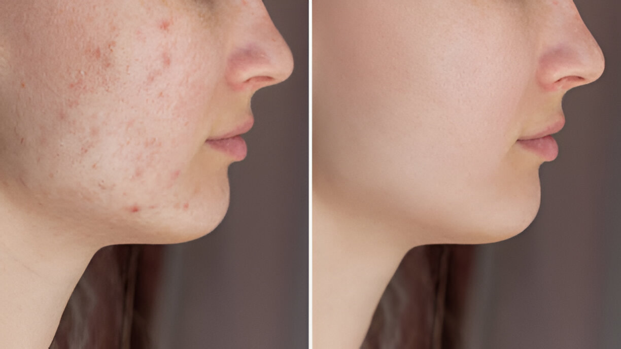 Acne Scar Treatment in Hyderabad | Dermatology & Aesthetics